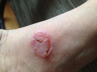 梦见腿上生疮周公解梦,梦见腿上生疮是什么意思?