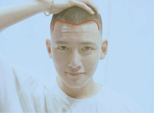 额头不平的男人